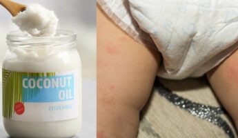 Is Coconut Oil Good For a Yeast Diaper Rash?