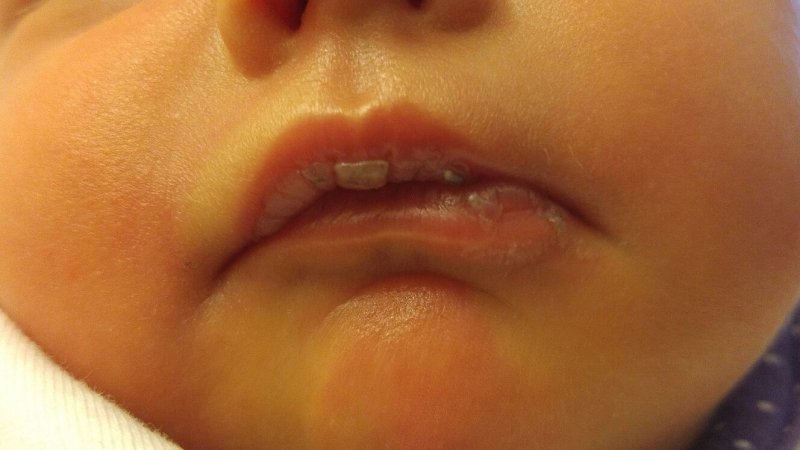 newborn chapped lips