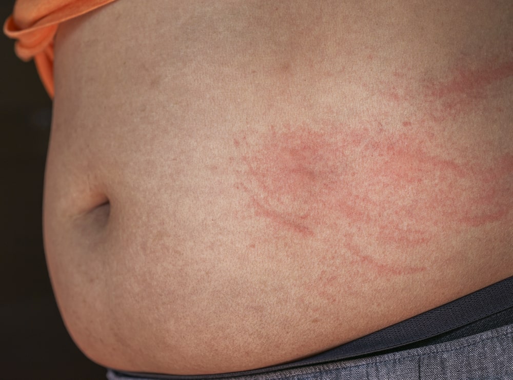 Why Do I Have a Rash On My Stomach After a C-Section?