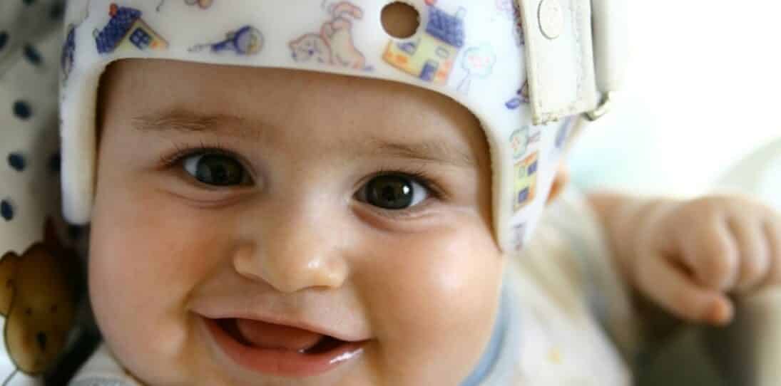 Why Do Babies Wear Helmets?