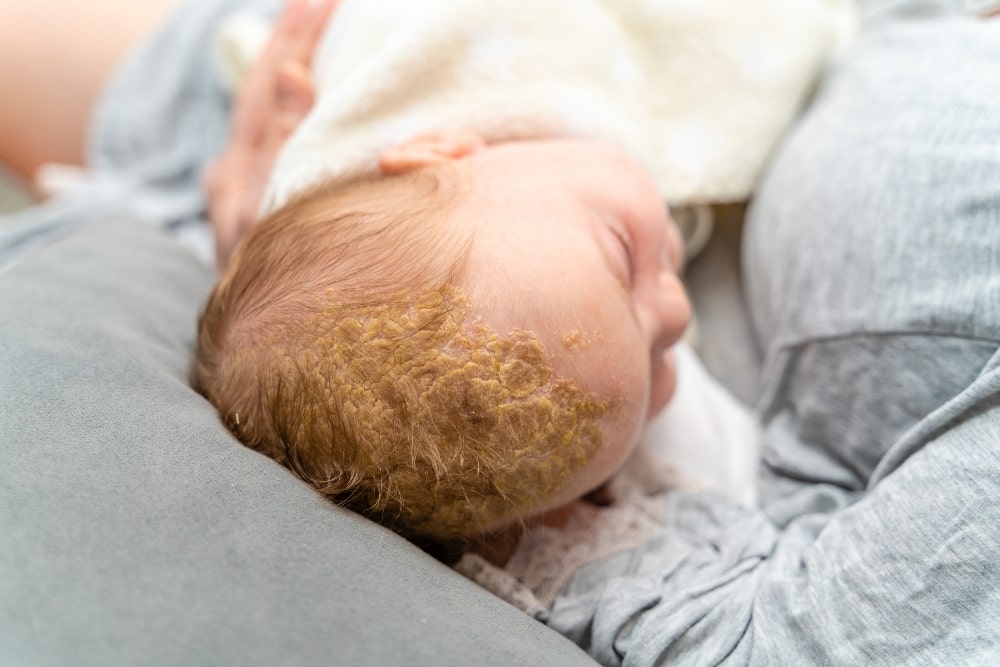 Does Cradle Cap Smell? Why Does My Babies Head Smell So Bad?
