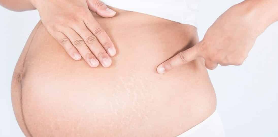 Can Stretch Marks Tear Open, Rip, or Bleed?