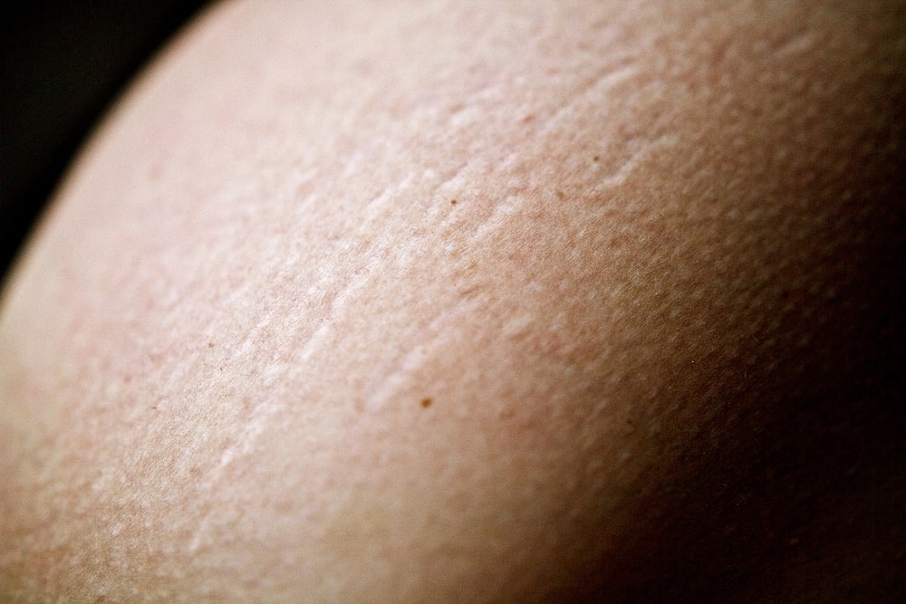 stretch marks on skin